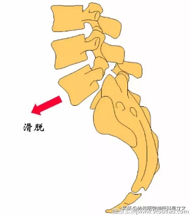 腰疼得厉害，除了腰突还可能是这个病