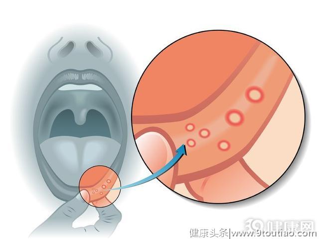 口腔溃疡：除了上火，也和“体寒”有关！该怎么调理好？