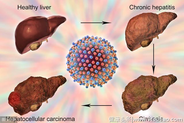 身体出现2个症状，可能是肝癌信号，做好3件事，肝脏1天比1天健康
