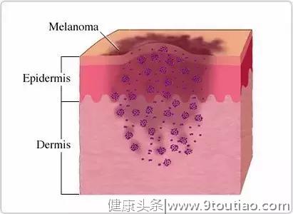 皮肤癌的症状及诊断