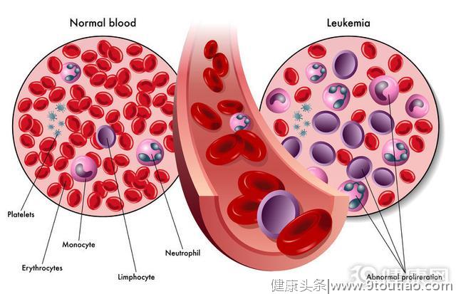 白血病发作时，一般会出现三个症状，仔细观察