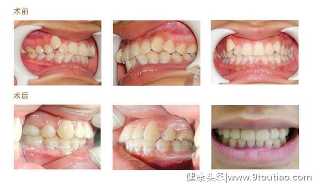 原来牙齿前突是有很多种原因造成的！