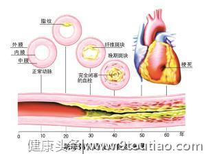 冠心病到底是个什么鬼？用最简单的话告诉你