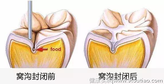 牙齿上有小黑点，怎么也刷不掉，怎么办？|口腔医生为你详细分析