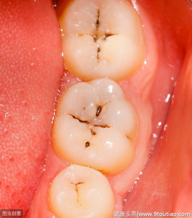 你的牙齿上有黑线吗？牙齿上有黑线，一定就是蛀牙吗？