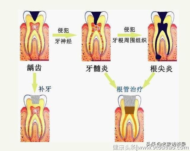 牙齿组织是人体最硬组织，为什么还会发生龋病吗？