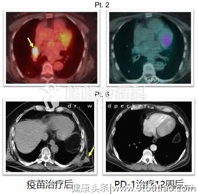 免疫治疗新前沿：具备治愈潜力的Neoantigen,个性化定制专属抗癌药