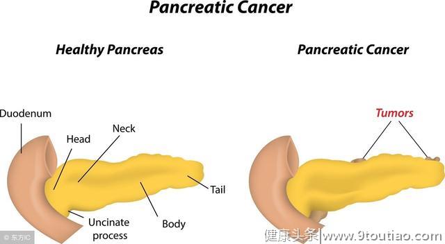 胰腺癌被称为癌症之王，出现三种症状的时候，提示癌症已是晚期