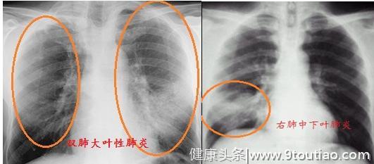 为什么一个普通感冒到医院就要花那么多钱？