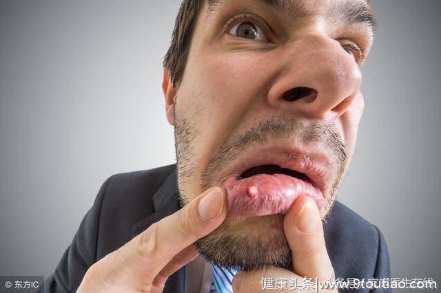 口腔反复发生溃疡？可能是身体发出的疾病信号，不能小瞧！