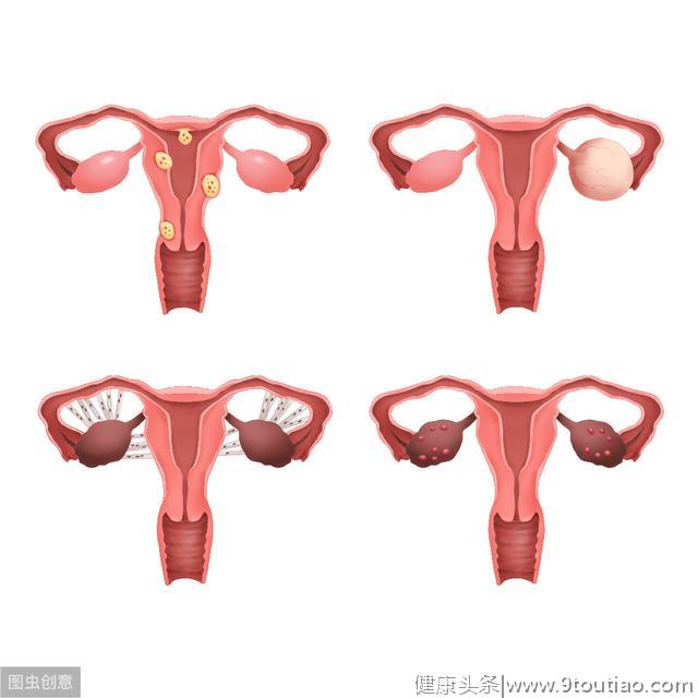 引起子宫肌瘤的主要原因有哪些？