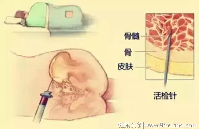 白血病的诊断及治疗