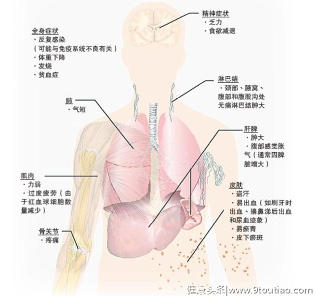 人，为什么会得白血病？这有一份深度解读