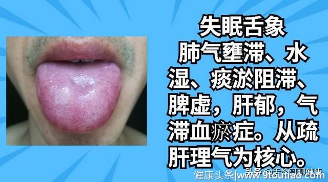 舌诊哥：口腔溃疡、疲劳乏力、情绪低落等舌象分析