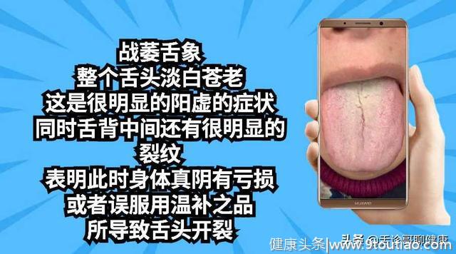 舌诊哥：口腔溃疡、疲劳乏力、情绪低落等舌象分析