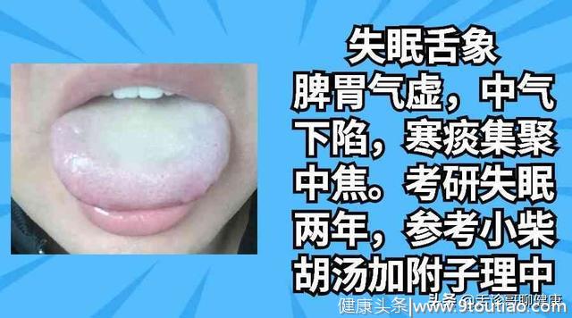 舌诊哥：口腔溃疡、疲劳乏力、情绪低落等舌象分析