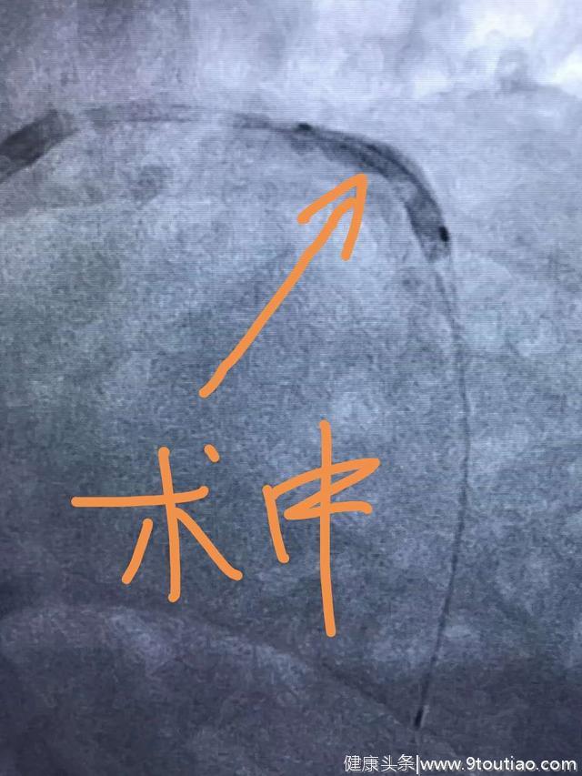 冠心病应该如何治疗？大概就这3种治疗方案，你应该知道！