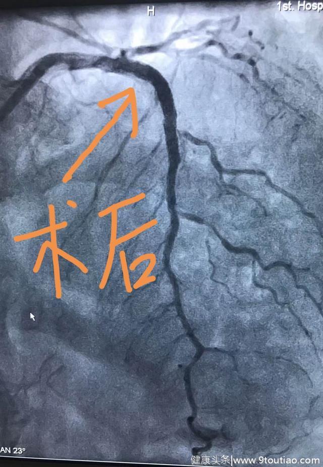 冠心病应该如何治疗？大概就这3种治疗方案，你应该知道！