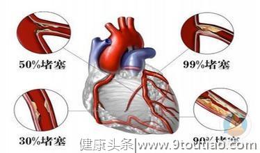 冠心病应该如何治疗？大概就这3种治疗方案，你应该知道！