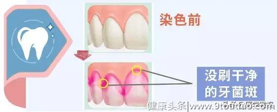 牙龈出血、蛀牙、牙周病？学会这3招，预防口腔疾病