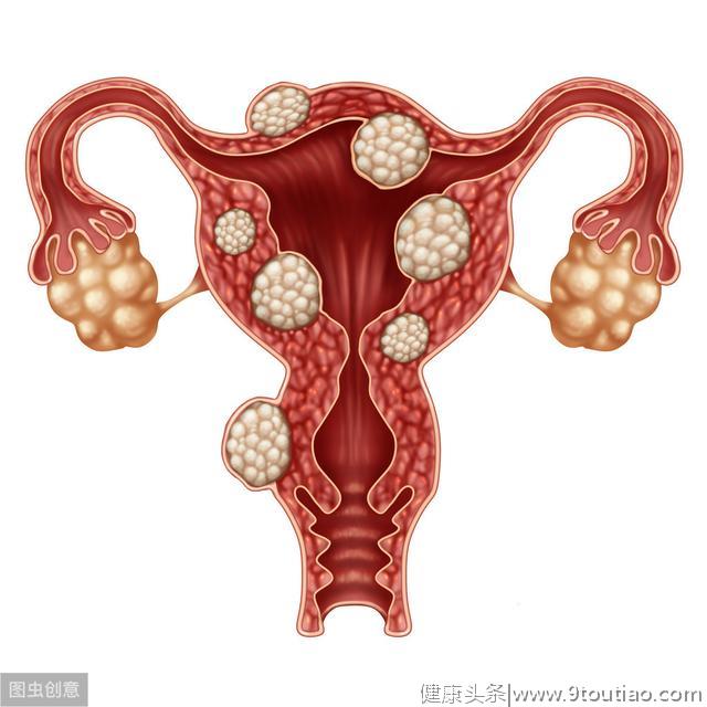 了解下面5种症状，帮你及早发现子宫肌瘤