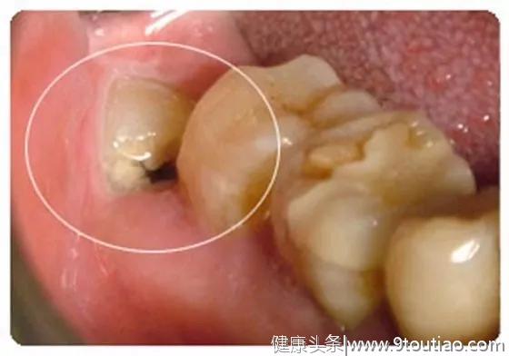 为啥牙医总爱劝人拔智齿？智齿，真的一定要拔掉吗？