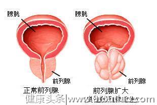 什么是前列腺增生？