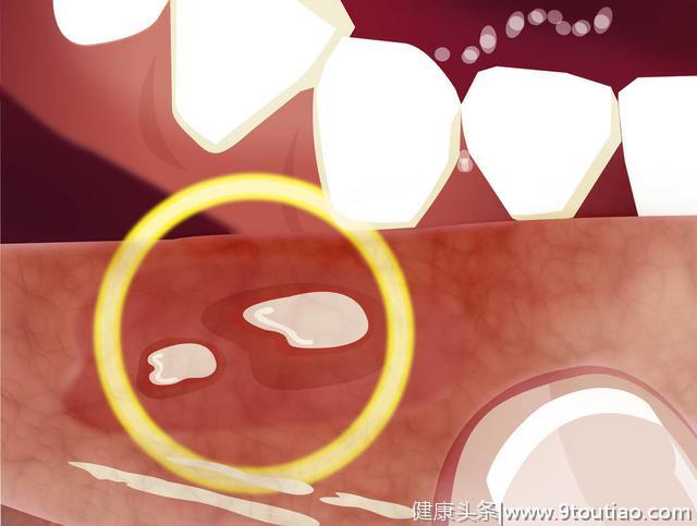 口腔溃疡又疼又难治愈？医生：用这2招逼退急性口腔溃疡只需1周