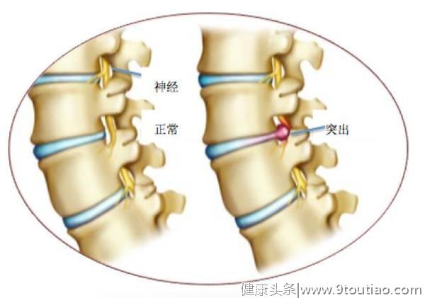 如何区分腰间盘突出、膨出？怎么保护腰椎？关于腰突的四个问题