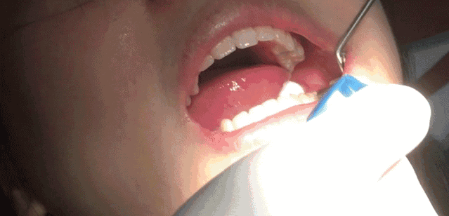 7成儿童蛀牙，千万别让6岁前的孩子自己刷牙