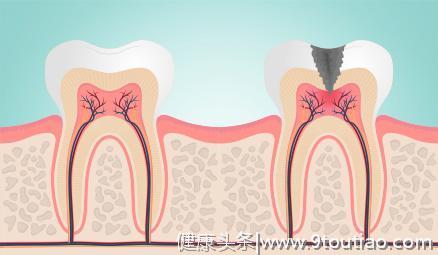 牙医Helen齿科中心——牙齿敏感的原因