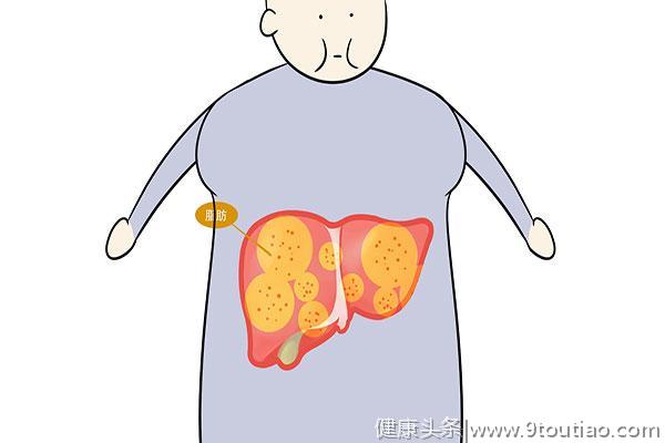 得了脂肪肝，身体可能会出现这5个异常，别忽视