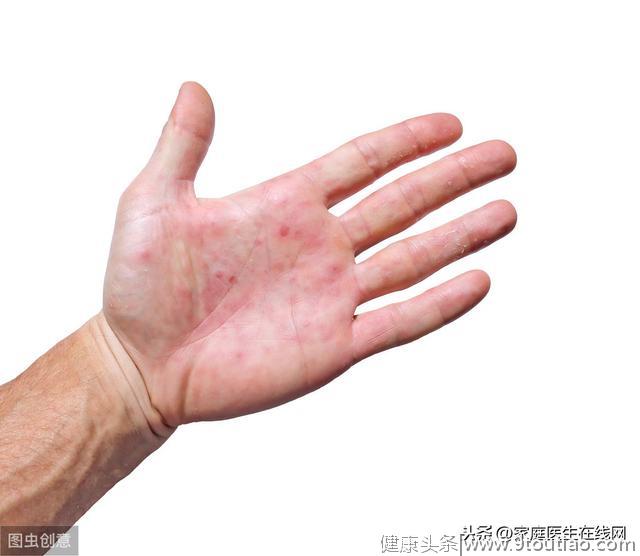 肝炎恶化，身体会发出哪些信号？留意双手3个异常
