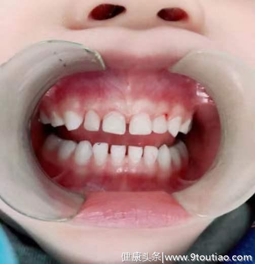 三岁幼童天天喊牙疼 哈医大口腔专家提醒：儿童乳牙龋齿需尽早治疗