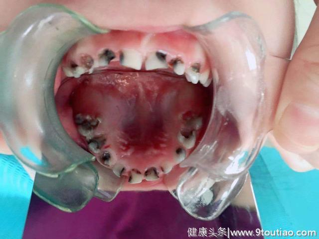 三岁幼童天天喊牙疼 哈医大口腔专家提醒：儿童乳牙龋齿需尽早治疗