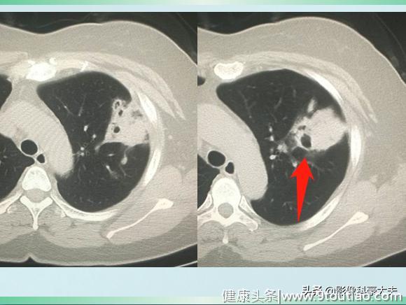 有些肺炎，比癌症还厉害