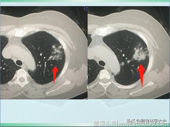 有些肺炎，比癌症还厉害