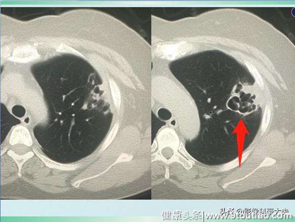 有些肺炎，比癌症还厉害