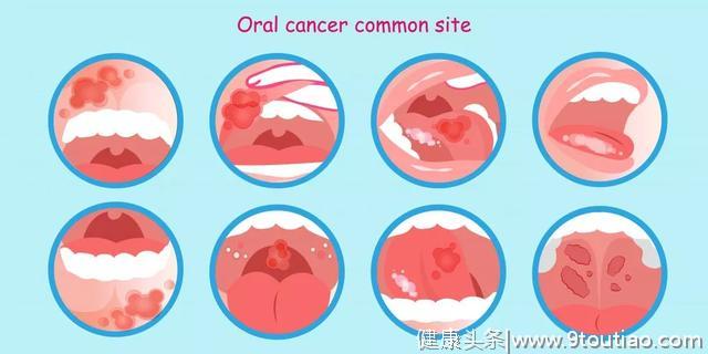 快速消除口腔溃疡的方法，你肯定没试过它