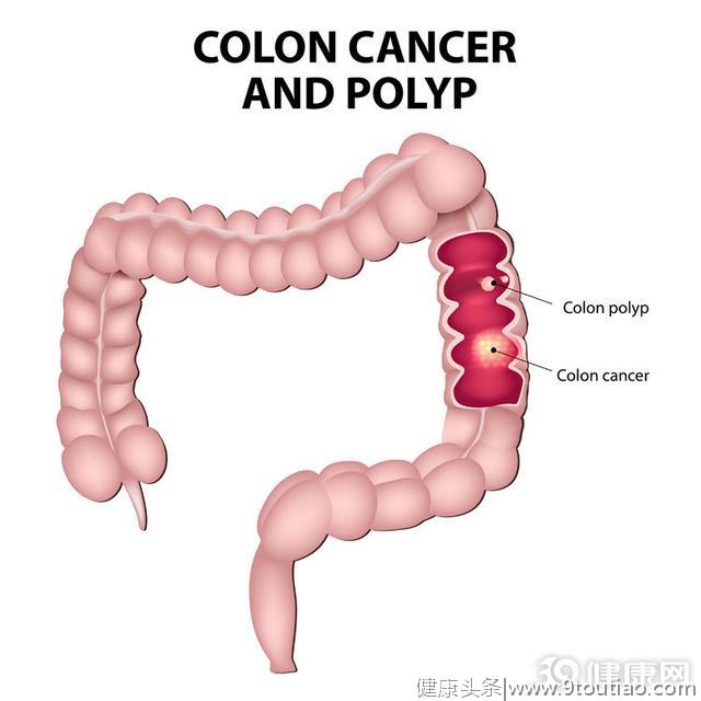 提醒：满足三个特征，你会引起肠癌的“注意”