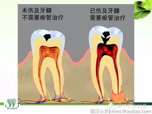 孩子这些牙齿问题不容忽视，需要及时治疗#葉子口腔科普#