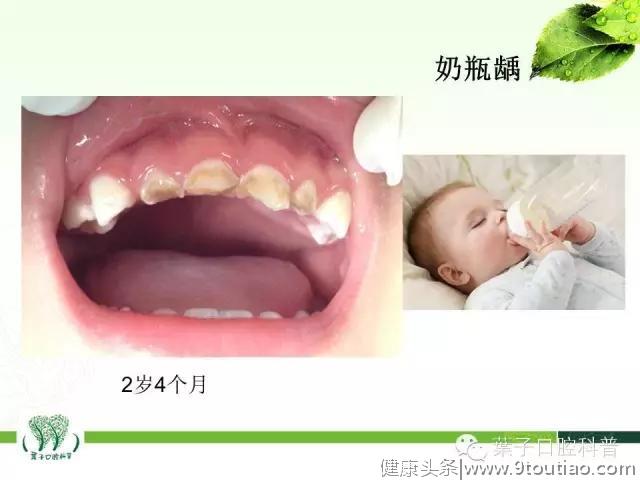 孩子这些牙齿问题不容忽视，需要及时治疗#葉子口腔科普#