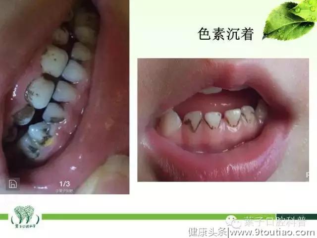 孩子这些牙齿问题不容忽视，需要及时治疗#葉子口腔科普#