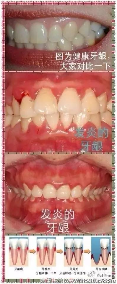 牙医Helen齿科中心——牙龈小科普