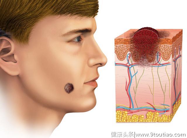 从肿瘤到癌症需要多久？有的人只需几个月！有的人终生未患癌