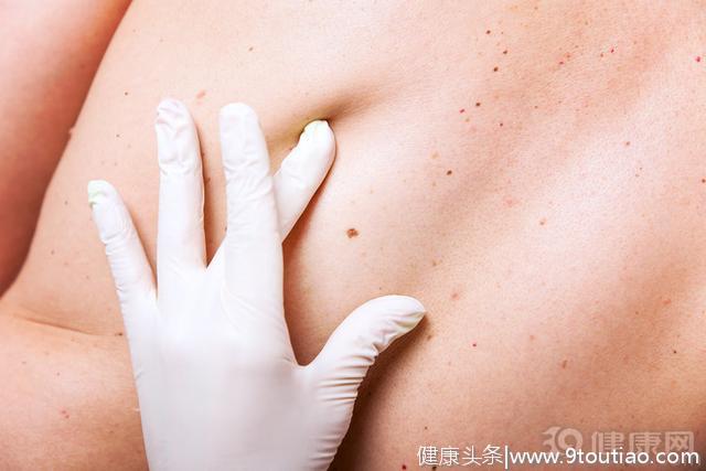 自查：皮肤上的痣有5个特征，说明皮肤癌在靠近！