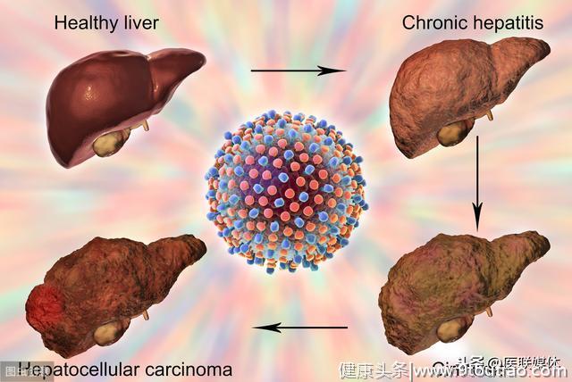 身上有5个“标志”，多是肝硬化“登场”了，请你别无视