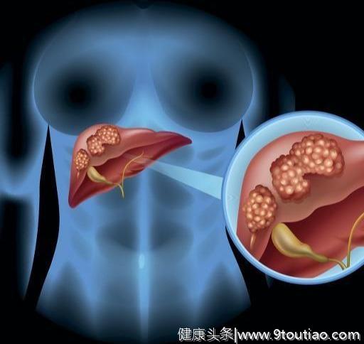 查出肝癌，你知道肝癌类型有哪些吗？