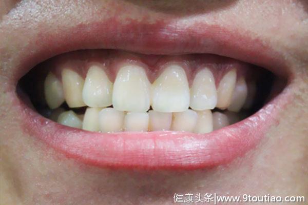牙齿黄黄的，刷几遍都刷不白，和什么有关？