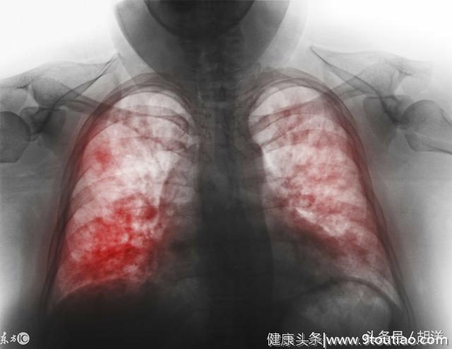 肺炎都有传染性吗？回答这个问题需要重新认识一下什么是肺炎